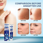 Wart Remover Ointment
