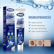Wart Remover Ointment
