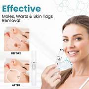Non-Invasive Mole and Wart Removal Laser Pen